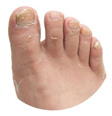 Feeter Gungusa uzrokuje