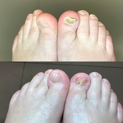 Iskustvo u korištenju promicil krem ​​barnaba iz Izraela, fotografije prije i poslije