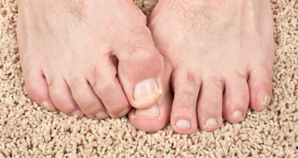 Simptomi gljiva noktiju