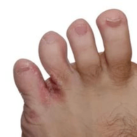 gljiva između prstiju