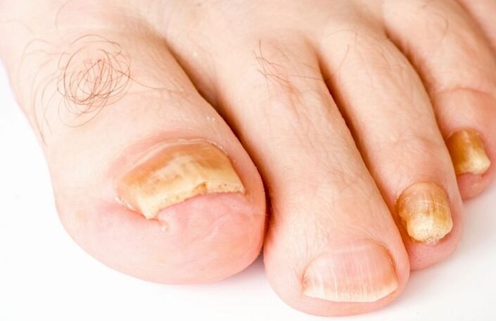 Gljiva na palcu noge