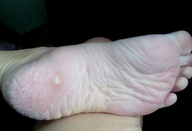 Liječenje gljivica laserom