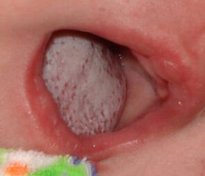 Lokalizacija bolesti s gljivicom