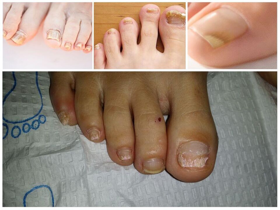 Gljivične bolesti ploča nokta