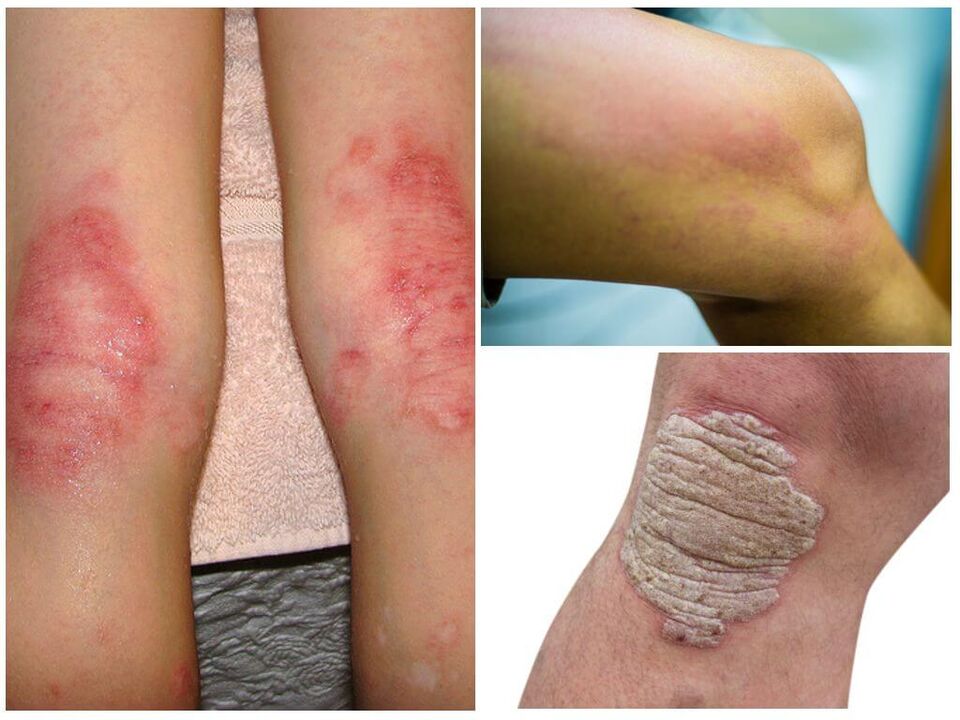 Gljivične infekcije koljena