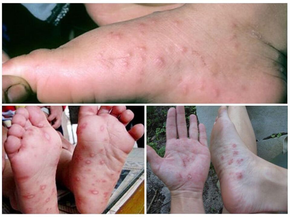 Hiperkeratotičke lezije stopala