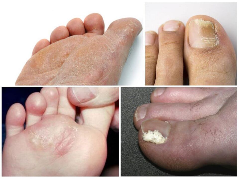 Početna faza gljivica stopala