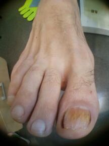 gljivice noktiju velikog prsta