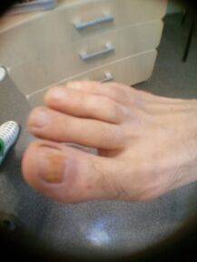 početni stadij gljivice noktiju velikog prsta