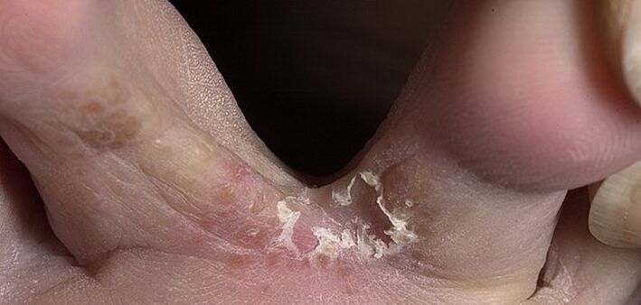 gljivice između nožnih prstiju