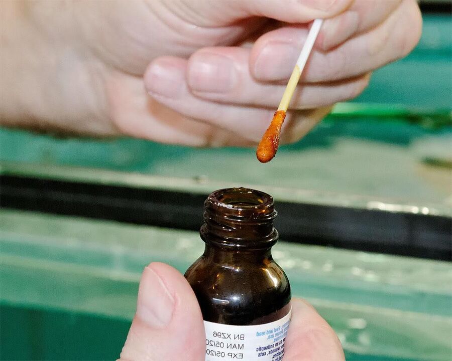 Nanošenjem mješavine joda i soka celandina na nokte na nogama riješit ćete se gljivica